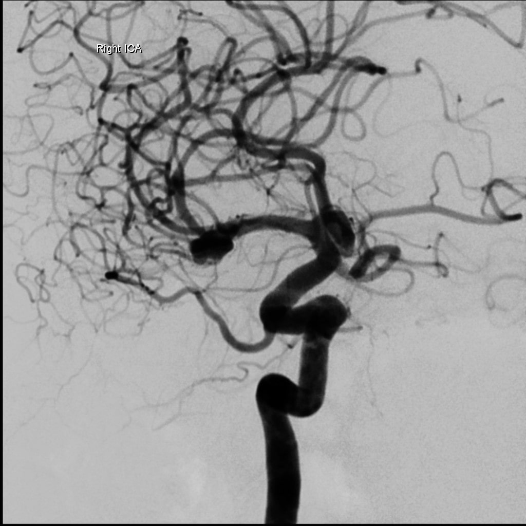 10-2 Anevrysme de lartre crbrale moyenne angiographie Anévrisme cérébral Tunisie