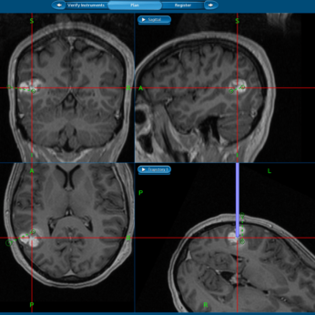 10-5 Cavernome temporal superficiel rvl par une pilepsie