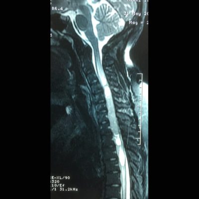 14-3-ependymome-intramedullaire-cervico_dorsal