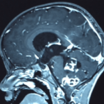 Chirurgie des tumeurs au cerveau tunisie Chirurgie des tumeurs au cerveau tunisie