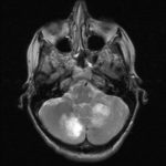7-6 metastases multiples Chirurgie des tumeurs au cerveau Tunisie