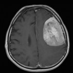 Méningiome de la convexité Chirurgie tumeur cérébrale Tunisie