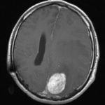 Méningiome parasagittal Chirurgie tumeur cérébrale Tunisie - Méningiome parasagittal