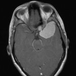 Méningiome de l’ailesphénoïdale Chirurgie tumeur cérébrale Tunisie - Méningiome de l’ailesphénoïdale