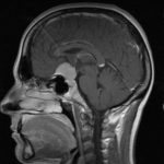 Méningiomesuprasellaire Méningiomesuprasellaire