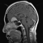 Chirurgie tumeur cérébrale tunisie Chirurgie tumeur cérébrale tunisie