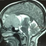 Méningiome olfactif Méningiomeolfactif