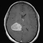 Chirurgie tumeur cérébrale tunisie Chirurgie tumeur cérébrale tunisie