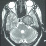 Chirurgie tumeur cérébrale tunisie Chirurgie tumeur cérébrale tunisie