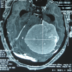 Méningiome de l'angleponto-cerebelleux Méningiome de l'angleponto-cerebelleux