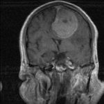 Méningiome de la faux du cerveau Chirurgie tumeur cérébrale Tunisie