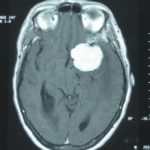 Méningiome de la clinoideantérieure Chirurgie tumeur cérébrale Tunisie