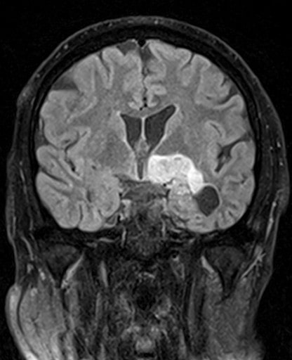 Chirurgie des tumeurs au cerveau tunisie Chirurgie des tumeurs au cerveau tunisie