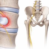 Illustration anatomique du nerf sciatique montrant une compression lombaire par hernie discale, le trajet du nerf du bassin jusqu’à la jambe et les zones de douleur sciatique