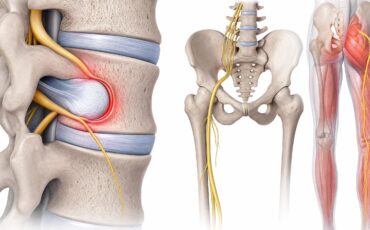 Illustration anatomique du nerf sciatique montrant une compression lombaire par hernie discale, le trajet du nerf du bassin jusqu’à la jambe et les zones de douleur sciatique